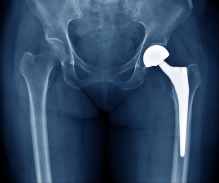 hip implant