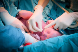 Caesarian section performed by the doctors.